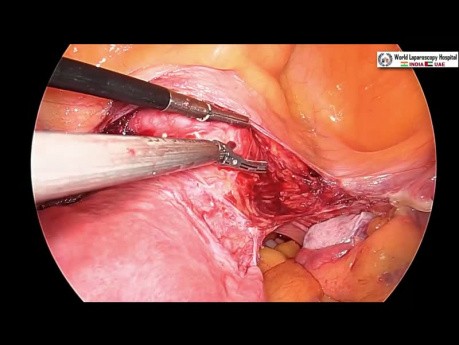 Totale laparoskopische Hysterektomie mit Indocyaningrün-(ICG)-Anfärbung 