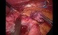 Laparoskopischer Magenbypass nach Fundoplikatio nach Nissen bei gastroösophagealer Refluxkrankheit