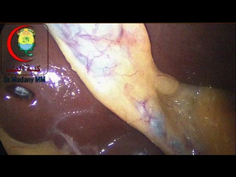 Ein Fall einer laparoskopischen Cholezystektomie, Nassar-Grad 1