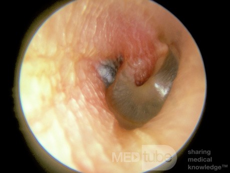 Herpes Zoster am äußeren Gehörgang und Trommelfell