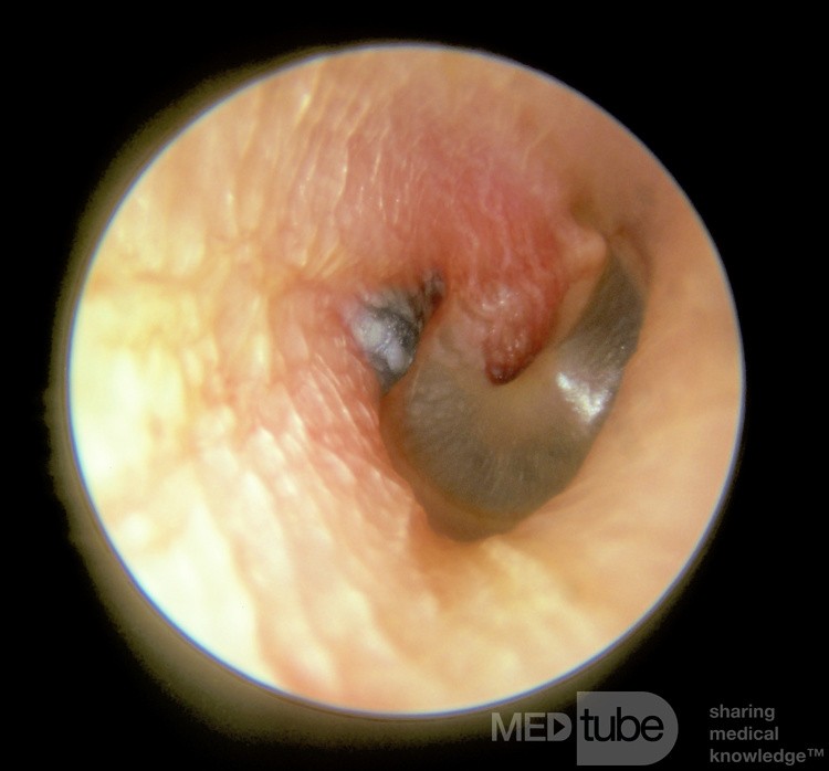 Herpes Zoster am äußeren Gehörgang und Trommelfell