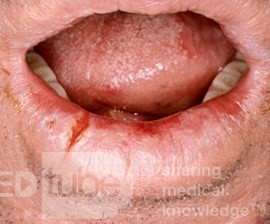 Rissige Lippe