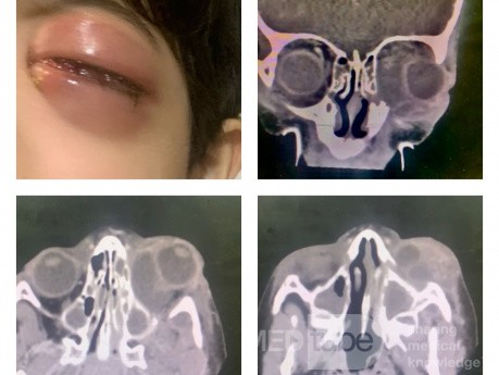 Akute Sinusitis kompliziert mit einem Abszess der linken Augenhöhle
