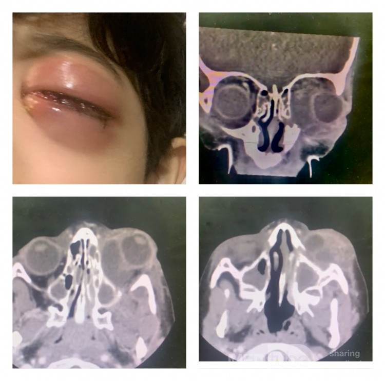 Akute Sinusitis kompliziert mit einem Abszess der linken Augenhöhle