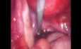 Endometrioma - Zystektomie mit einem Foley-Katheter