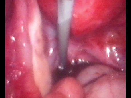 Endometrioma - Zystektomie mit einem Foley-Katheter