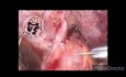 Laparoskopische Erkundung des gemeinsamen Gallengangs und Anastomose nach fehlgeschlagener ERCP