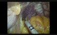 Eine dreitrokare laparoskopiche Sleeve-Gastrektomie