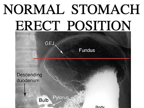 Chirurgische Radiologie der gastroduodenalen Erkrankungen