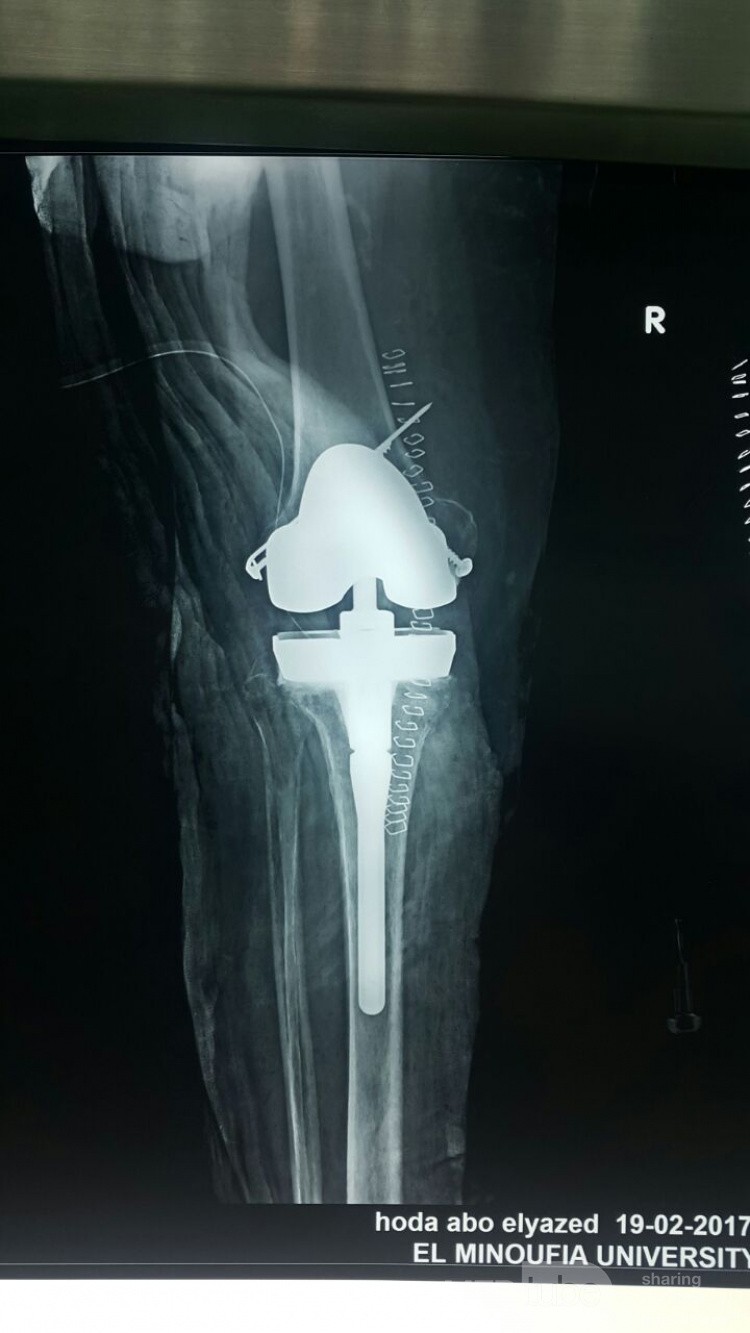 Postoperatives Röntgenbild nach Knieendoprothetik