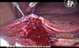 Kontrolle der blutenden Sinusoide des Gallenblasenbetts