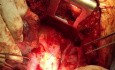 Traumatische Aortentranssektion