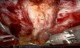 Robotische Bottom-up-transabdominelle R-PeTEP-IIP-Rekonstruktion bei Rektusdiastase und Umbilikaltumorektomie