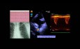 Fallbeispiel: Koarktation der Aorta - EKG, Echokardiografie und Therapie