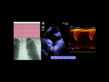 Fallbeispiel: Koarktation der Aorta - EKG, Echokardiografie und Therapie