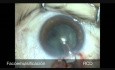 Ein-Port-Phakotrabekulektomie bei Patienten mit radialer Keratotomie und Glaukom