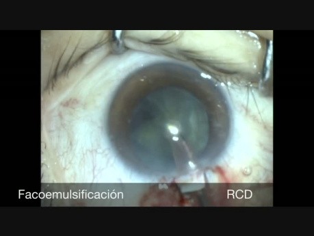 Ein-Port-Phakotrabekulektomie bei Patienten mit radialer Keratotomie und Glaukom