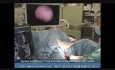 Hysteroskopische Entfernung vom Myom am Gebärmutterhals (Zervix)