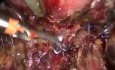 Recto-vaginaler Knoten
