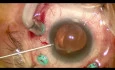 Subluxation der einteiligen IOL - vordere Kapsulorhexis und 'Optic-capture'