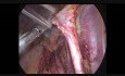  Becken-Lymphadenektomie während der radikalen Hysterektomie nach der Wertheim-Methode