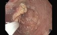 Flaches gastrisches Adenom - Resektion