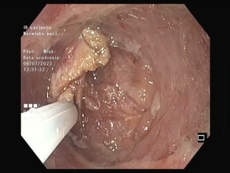 Flaches gastrisches Adenom - Resektion