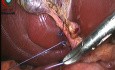 Verschluss des Ductus cysticus mit einer Naht-Ligatur
