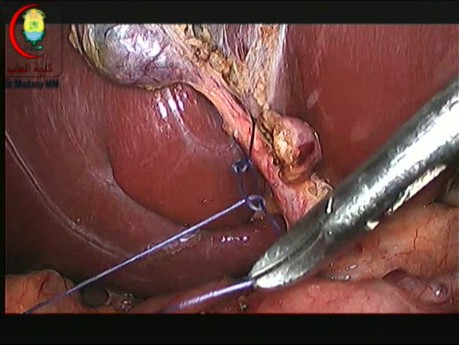Verschluss des Ductus cysticus mit einer Naht-Ligatur