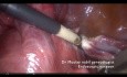 Hysterektomie bei einer Patientin mit Gefäßverwachsungen des Omentum