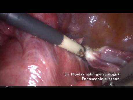 Hysterektomie bei einer Patientin mit Gefäßverwachsungen des Omentum
