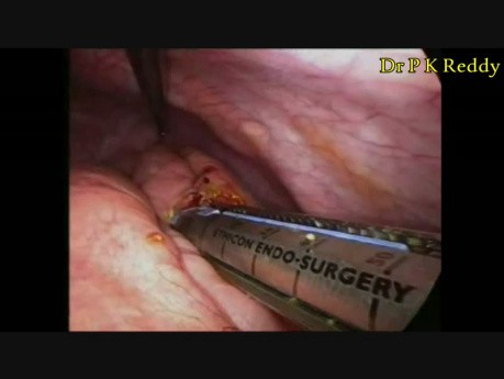 Laparoskopische Exzision von der Choledochuszyste mit Hepaticojejunostomie