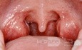 Normale Mandeln