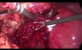 Laparoskopische Cholezystektomie bei akuter Cholezystitis. Behandlung von Blutungen aus dem Gallenblasenbett