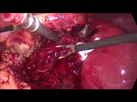 Laparoskopische Cholezystektomie bei akuter Cholezystitis. Behandlung von Blutungen aus dem Gallenblasenbett