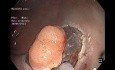 Endoskopische Submukosadissektion einer kleinen Läsion im Rektumbereich