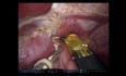 Robotergestützte linksseitige Hepatectomie und partielle kaudale Resektion 