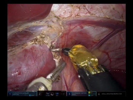 Robotergestützte linksseitige Hepatectomie und partielle kaudale Resektion 
