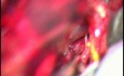 Clipping eines Basilararterien-Aneurysmas