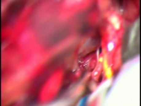 Clipping eines Basilararterien-Aneurysmas