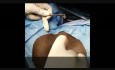 Schließmuskelschäden Reparatur - Plastik der Sphincter Ani