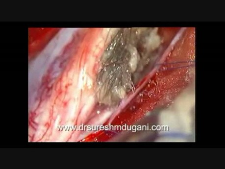 Intraspinales Dermoid