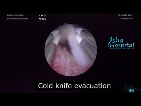 Hysteroskopische Entfernung einer Extrauteringravidität in einer Narbe Typ 1