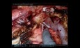 Robotische Whipple-Chirurgie (AHPBA 2019)