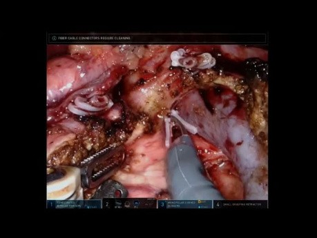 Robotische Whipple-Chirurgie (AHPBA 2019)
