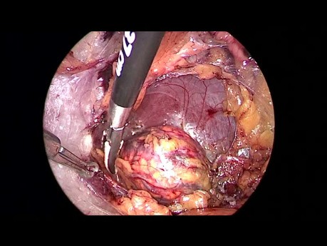 Retroperitoneale laparoskopische Adrenalektomie (Conn-Syndrom)