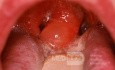 Akute Ödem der Uvula