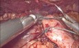 Antireflux-OP bei GERD - Fundoplikatio nach Nissen