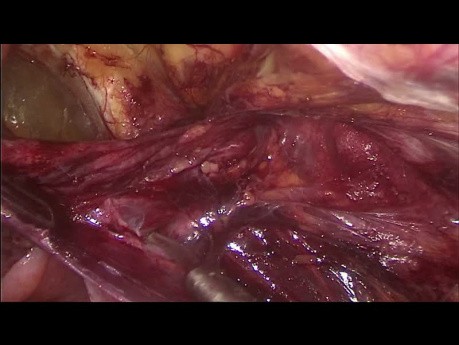Laparoskopische Therapie zur Behandlung von Inguinal- und Femoralhernien
