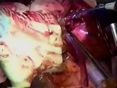 Herz- und Lungentransplantation in Schnellfolge